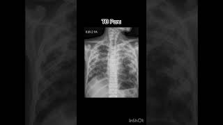 Tb paru  kasus 7 amp 8 xray radiology röntgen tbc [upl. by Ycak]