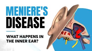 Menieres Disease  Inner Ear Impacts [upl. by Cathyleen]