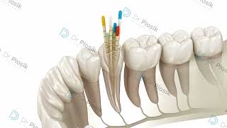 leczenie endodontyczne zęba [upl. by Erek]