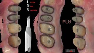 BOPT amp Intra Oral Scanner [upl. by Ianthe351]