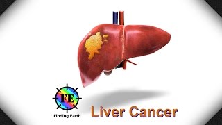 Liver Cancer  Symptom Causes amp Diagnosis Finding Earth [upl. by Vincenta]