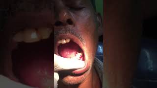 mandibular second premolar extraction [upl. by Poll]