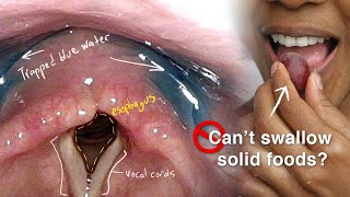 Cricopharyngeal Dysfunction Difficulty Swallowing Especially Solid Foods [upl. by Kevan]