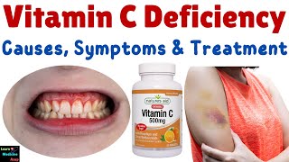 Vitamin C Deficiency – Causes Symptoms Diagnosis Treatment amp Prevention [upl. by Kam177]