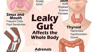 6 Steps to Heal Leaky Gut and Autoimmune Disease Naturally  Health Vlogger [upl. by Lowell845]