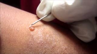 Removing H P Body From Molluscum Contagiosum [upl. by Adnuahsor]