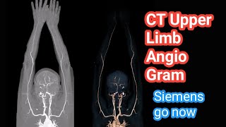 CT scan upper limb angiography [upl. by Latvina286]