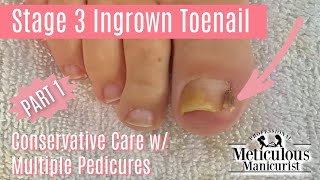 How to Pedicure Stage 3 Ingrown Big Toe with Granulation Tissue [upl. by Novyert273]