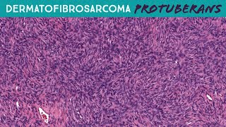 DFSP with perfect storiform pattern Fibrosarcomatous Dermatofibrosarcoma Protuberans Yale case 6 [upl. by Doralia831]