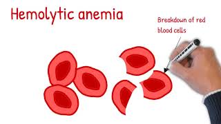 Hemolytic anemia made easy Intrinsic vs extrinsic hemolytic anemia [upl. by Laeynad881]