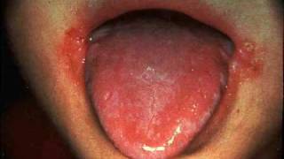 Angular Stomatitis  Learn About Symptoms Causes Treatment Remedies and More [upl. by Starlene155]