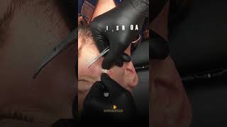 Epidermoid cyst removal [upl. by Singband215]