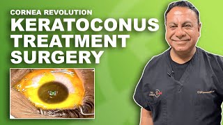 Keratoconus Surgery Laser Treatment [upl. by Nirahs]