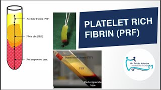 PLATELET RICH FIBRIN PRF IN PERIODONTICS BIOLOGIC PROPERTIES PREPARATION PRF MEMBRANE PRF PLUG [upl. by Edmonda]