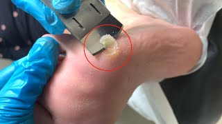 Callus removal from feetampFoot scraping dead skin【Xiao Yan pedicure】stress 1109 [upl. by Esyned894]