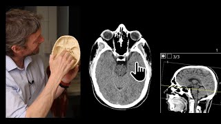 Paranasal sinuses CT imaging anatomy [upl. by Ybor]