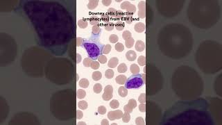 Infectious “Mono” Mononucleosis under microscope peripheral blood smear EBVEpsteinBarr Virus [upl. by Ojyram]