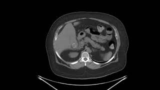 Acute cholecystitis with tensile fundus sign [upl. by Goodden56]