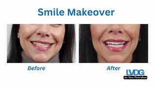 Smile Makeover Las Vegas Dental Group Cosmetic Dentistry 7028705165  smilemakeoverlasvegas [upl. by Ilwain]