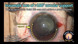 CataractCoach 1232 traumatic loss of zonular support [upl. by Puduns]