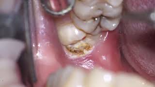 operculectomy of mn 3dr molar [upl. by Eelydnarb]