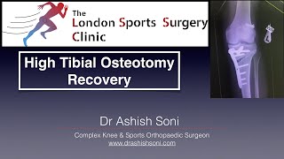 High Tibial Osteotomy recovery [upl. by Ennaira431]