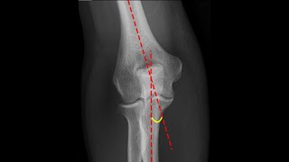 Normal elbow  Carrying angle and its importance [upl. by Lejeune380]