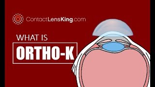 What is Orthokeratology or OrthoK [upl. by Theo]