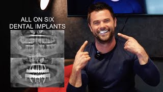 All on six dental implant in Turkey Antalya Best dental treatment in Antalya Turkey  Testimonials [upl. by Inanaup665]