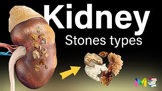 TYPES OF KIDNEY STONES [upl. by Aliuqa]