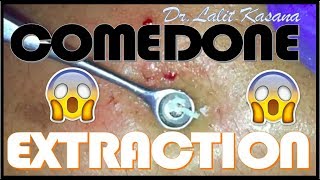 COMEDONE EXTRACTION  ANTI ACNE THERAPY BLACKHEAD REMOVAL [upl. by Emirac]