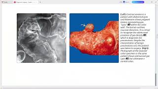 SMALL INTESTINE IMAGING DIAGNOSTIC IMAGING [upl. by Staten836]