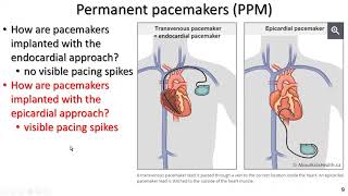 Permanent pacemakers and implantable cardiac defibrillators for exercise professionals the basics [upl. by Dixie]