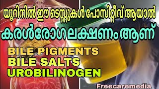 Bilirubin test in urine Bile pigments  Bile salt  Urobilinogen liver disease urine [upl. by Riess]