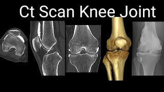 How I do ct scan knee joint  chip fracture tibia intercondylar region Trauma [upl. by Samella865]