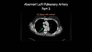 Aberrant Left Pulmonary Artery Part 3 radiology radiologist anatomy [upl. by Ynnub810]