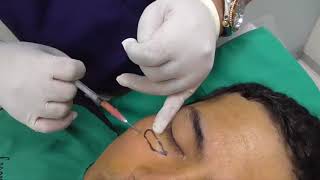 REJUVENECIMIENTO LIPOFILLING FACIAL  Dr César Calderón cirujano plástico [upl. by Jarlen]