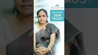 How to treat Skin Tag  Skin Tag removal  TAMIL  Dr Yamini  Helios skin hair amp laser clinic [upl. by Pietrek]