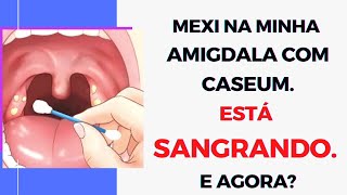 Caseo amigdaliano o que fazer quando a AMIGDALA SANGRA após cutucar mexer para tirar o caseum [upl. by Kallista177]