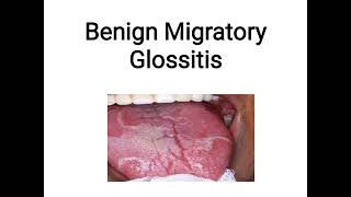 benign migratory glossitis [upl. by Arvad]