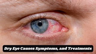 Managing Severe Dry Eye Cases Causes Symptoms and Treatments [upl. by Alin]