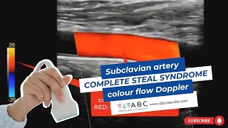 Subclavian artery complete steal syndrome colour flow Doppler Carotid Doppler  Ultrasound [upl. by Balthasar598]