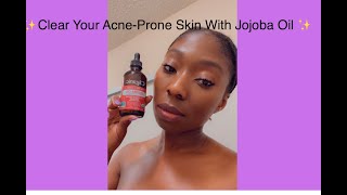 Clear Your AcneProne Skin With Jojoba Oil [upl. by Mae742]