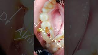 Single Visit Endodontic Treatment الكربولة endodontics dental [upl. by Etireugram722]