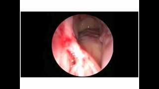 Balloon Sinus Dilation of the Frontal Sinus  Performed at the St Louis Sinus Center [upl. by Liu902]