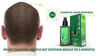 Green Wealth Neo Hair Lotion  3 Month Usage Progress [upl. by Lewak]