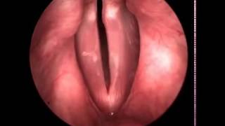 High Speed Video of the Vocal Folds [upl. by Angelo]