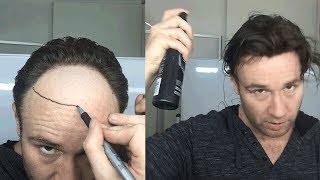 Video 46 An Idiots Guide to Removing Baldness in one day [upl. by Grayson]