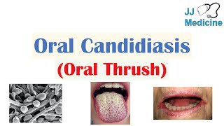 Oral Candidiasis Oral Thrush  Causes Pathophysiology Signs amp Symptoms Diagnosis Treatment [upl. by Lipscomb859]