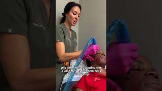 My microneedling treatment  Microneedling is percutaneous collagen induction [upl. by Gerita]